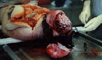 Exhibit 1: Autopsy photos of brain and calvarium.
